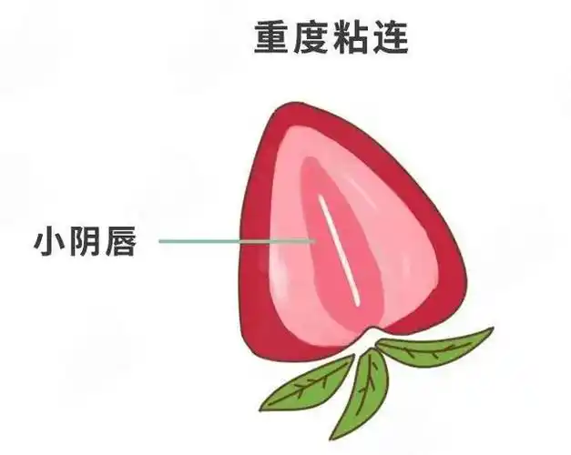 而这时的阴道口,尿道口已经完全不能暴露,娃小便时会出现哭闹或者像排