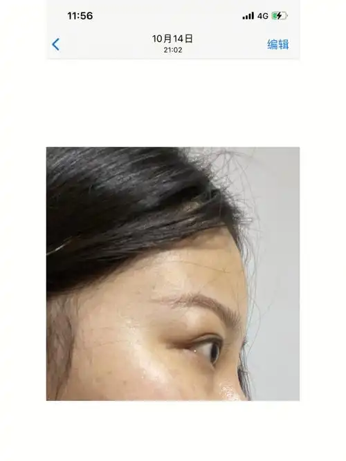 八月底已经打完两边各三针,眼睑退缩大概下去了.