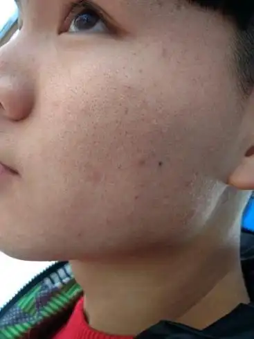 脸上毛孔比较大有黑头有螨虫怎么会好点,油性皮肤,男性