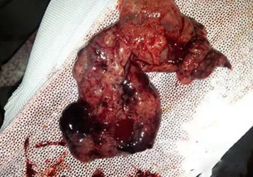 怀孕十几天流产图片_有来医生