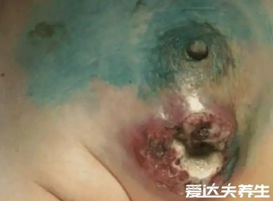 乳房癌症的早期信号及症状图片出现疼痛和肿