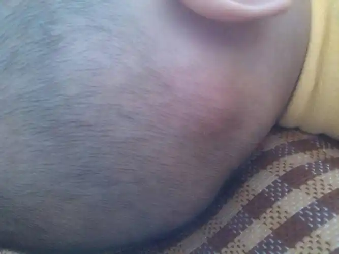 其他回答 就是淋巴结肿大吧,吃点消炎药,然后增强免疫力  而已