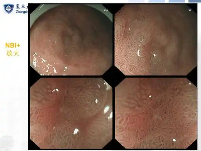 早期胃癌或癌前病变的胃镜精查和esd治疗 - 好大夫在线