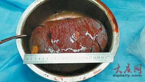 23岁小伙儿腹中巨脾达7斤 常人如拳头他的却如篮球(图)