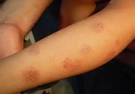 各种湿疹性红疹图片初期症状图片对照查看大全