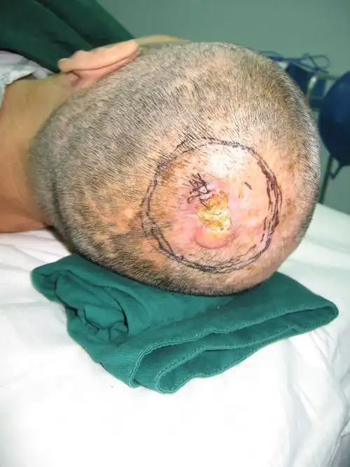 头皮鳞状细胞癌的治疗 - 好大夫在线