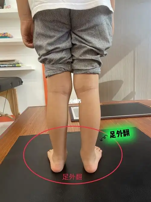 5岁小盆友中重度足外翻