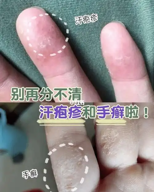 汗疱疹和手足癣到底怎么辨别?_手癣_发病_区别