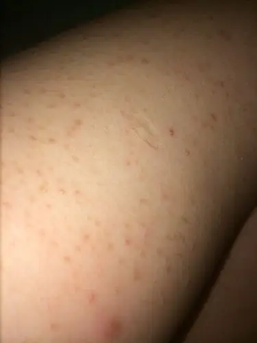 胳膊上密密麻麻的褐色的点