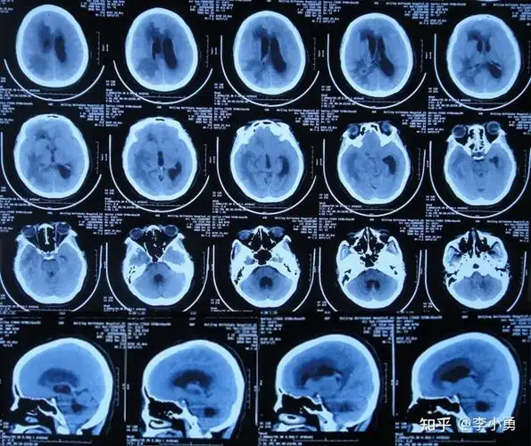 先天心脏病并发脑脓肿和脑积水,反复头痛恶心发热视力模糊不认识人