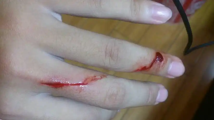 被没生锈的刀砍了一下,这伤口只用酒精消毒的话会得破伤风么