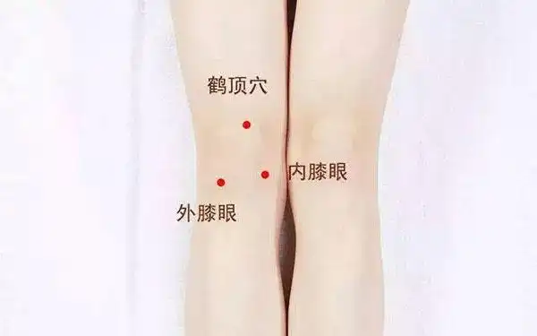 艾灸治疗膝关节炎时选取膝眼穴,能够刺激局部经络,激发人体自身