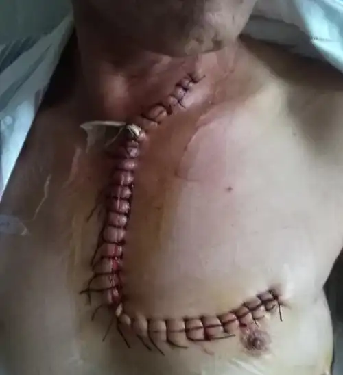 胸外二科成功完成经胸骨柄"l"型切口切除复杂的颈胸结合部肿瘤术,刷新