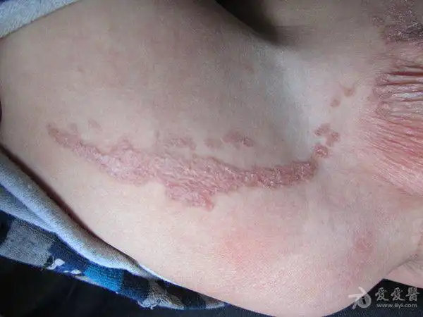 病历讨论线状表皮痣