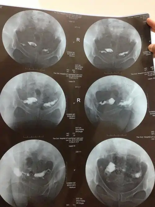 一张图看懂输卵管性不孕症,秒懂有木有