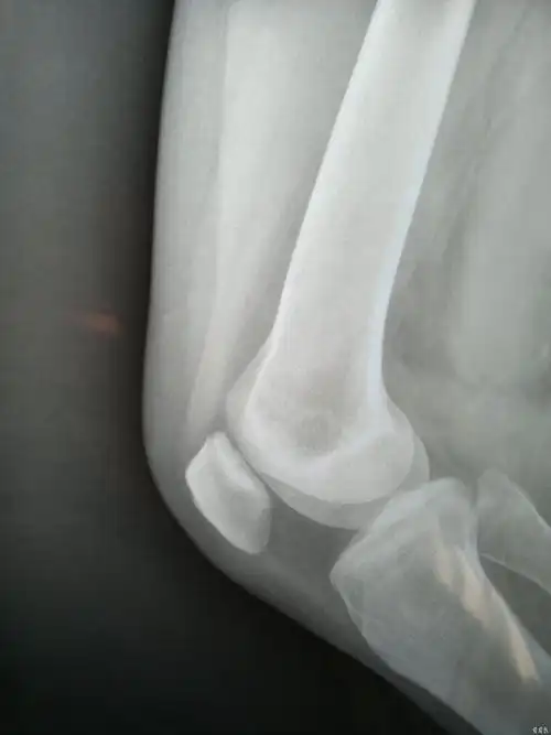 右膝关节伸膝位时向上推动髌骨下缘疼痛加剧