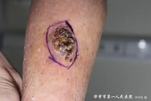 皮肤科成功为一86岁患者左小腿多发鳞状细胞癌行手术治疗-临床一线
