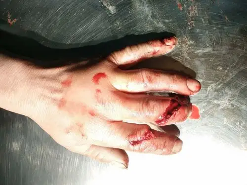 食中指电锯伤