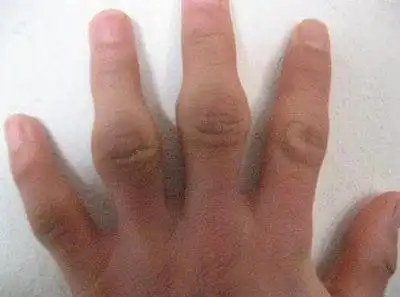 手指关节肿大疼痛的原因有哪些呢