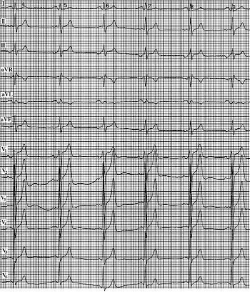 房性逸搏和逸搏心律