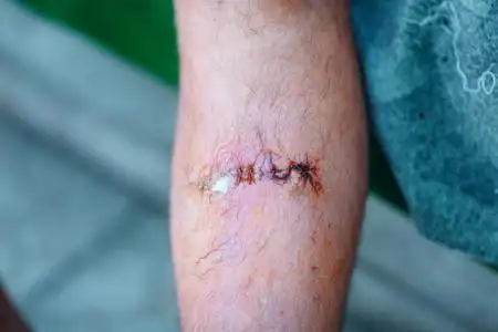 疤痕静脉曲张手术后妇女的腿有可见的手术缝合线缝针和一条腿上的伤口