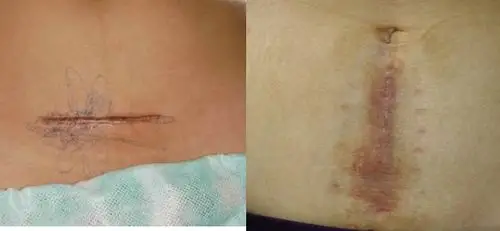 血腥惊恐剖腹产现场实拍