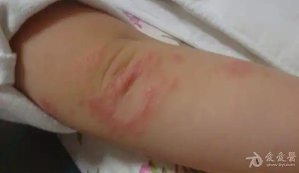 18个月幼儿脓疱疮转湿疹