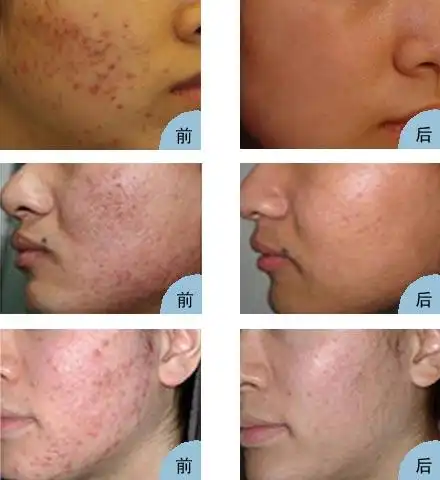 痤疮治疗-祛痘祛痘印-yestar艺星整形(成都)