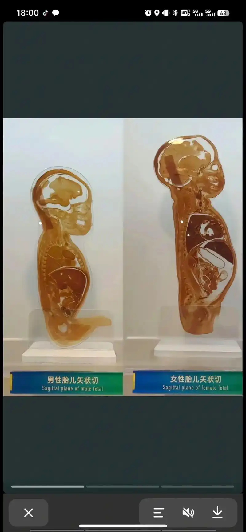 男性胎儿和女性胎儿的彩超图,自己就可以辨别啦,备孕的麻麻们可 - 抖