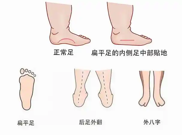 孩子扁平足要不要治疗出现这些情况一定要去看医生