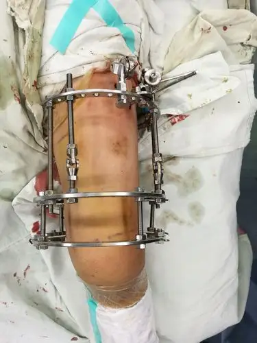 闭复支架外固定治疗儿童股骨干骨折