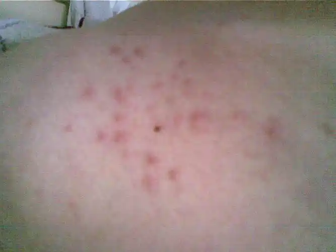 前胸和后背上长了红色的小包怎么办