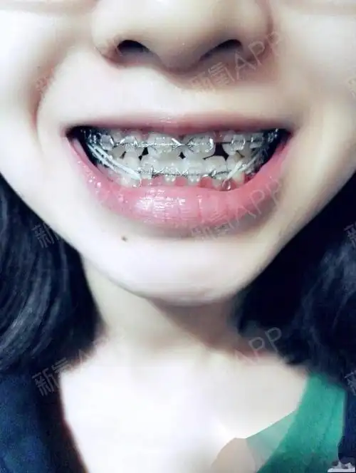 牙列稀疏和过小牙,不拔牙正畸