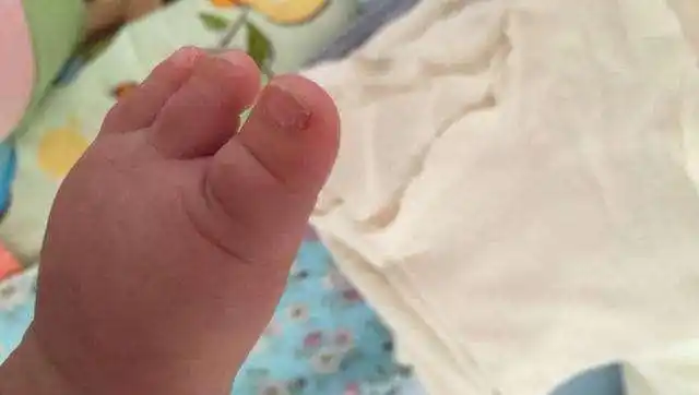 宝宝脚趾甲发黄变厚,或许是患了这个病,快脱掉孩子袜子对比