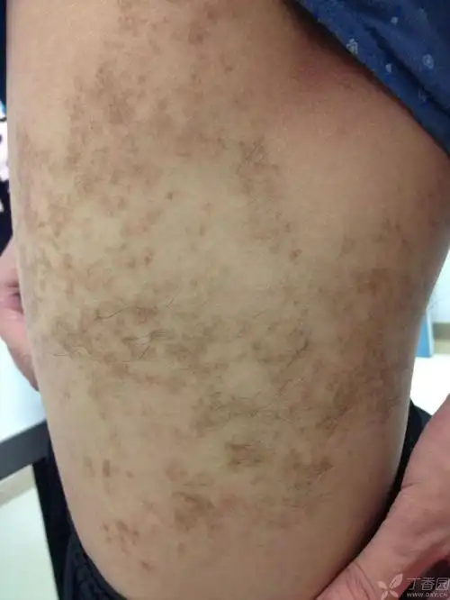 看图诊断-becker痣