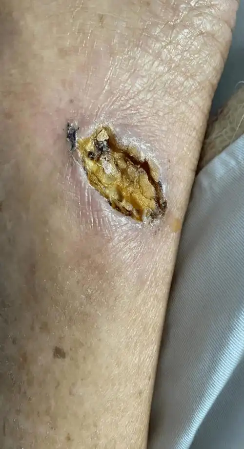 原创科普丨伤口结痂了,就是快好了吗?