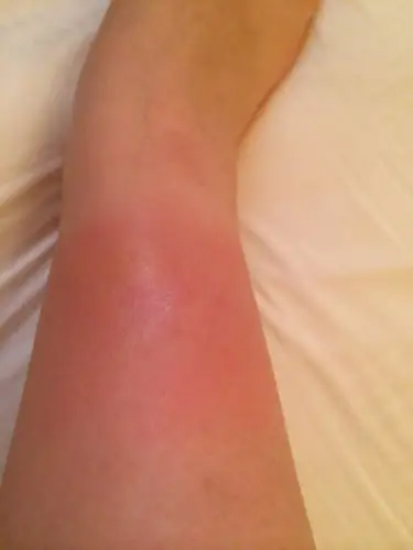 蚊子咬完为什么肿这么大.解决方法是什么.