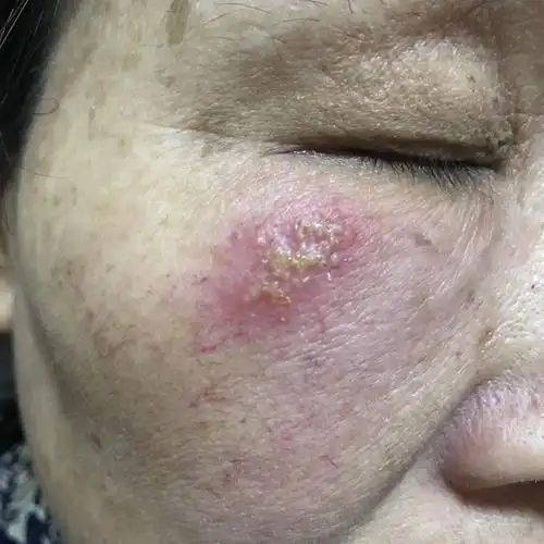 最近频繁艾灸…但并没有艾灸面部,不知道有没有关系