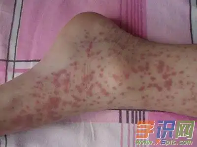 什么是出血性紫癜_出血性紫癜的治疗