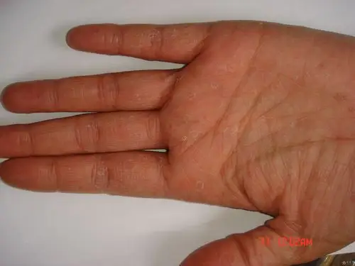 看看这个病人的手掌皮肤,请高手确定一下是何病?