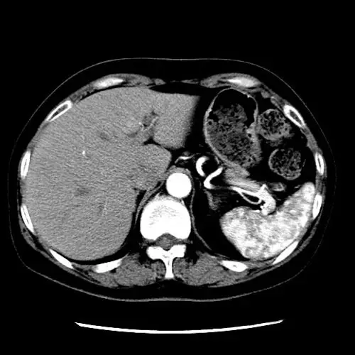 【求助】左肾积水(无功能),腹膜后一包快 [病例帖]