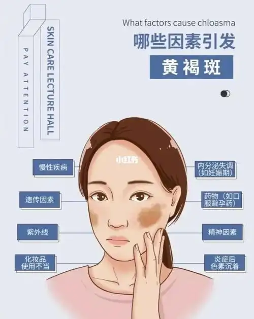 也就是说, 想了雀斑就更容易长黄褐斑,长了黄褐斑更容易长老年斑.