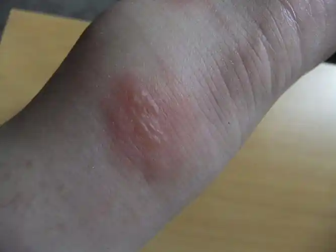 这个是被什么虫子咬了吗?脚后跟,摸起来有一粒粒的小硬点,会痒会肿.