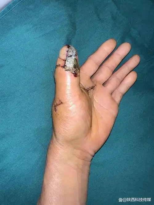 近日,陕西中医药大学第二附属医院皮肤整形科-手足显微外科专业组成功