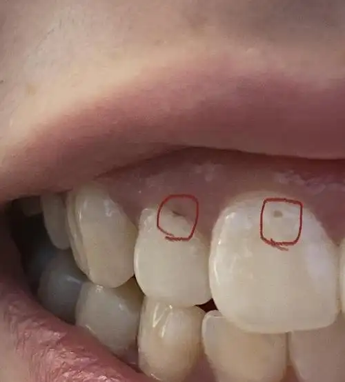 友友们,请问牙齿上有这种小黑点是蛀牙吗?要管它吗