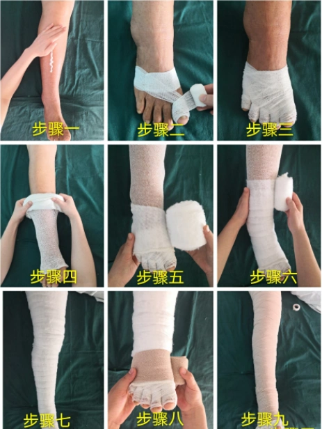 无需接受外科手术治疗,现有手术方法除截肢手术外均不能治愈淋巴水肿