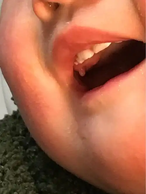 一岁婴儿口腔牙床长了个肉芽有图!_食鬼人_ 医院_ 淘股吧