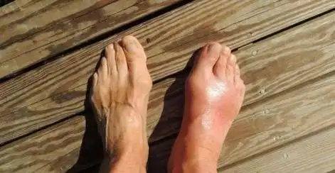 类风湿关节炎有什么症状表现