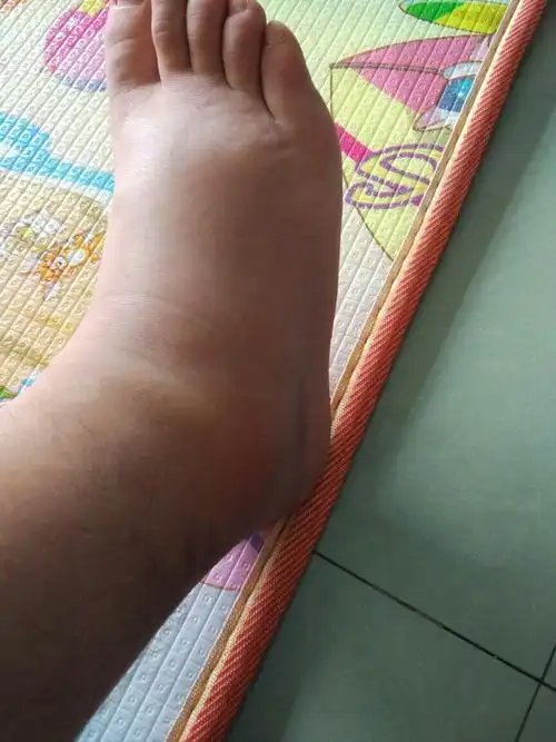 前天篮球时把脚扭伤了,这两天慢慢开始肿起来了.