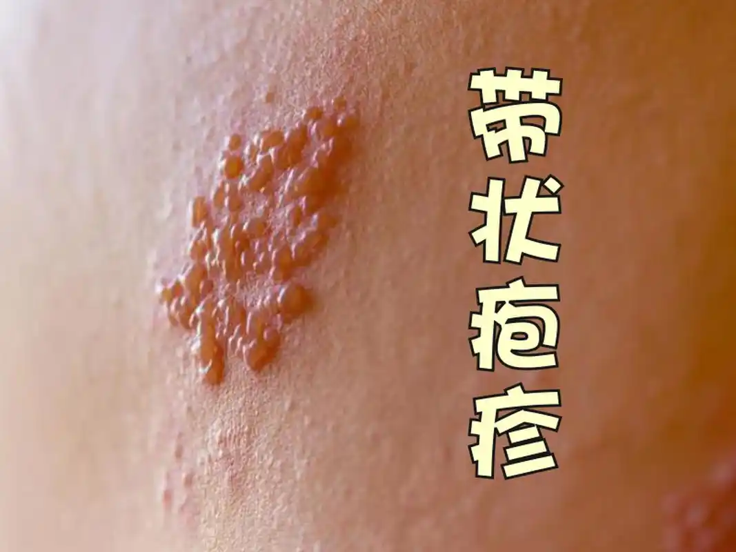 什么是带状疱疹?